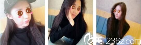 韓國(guó)奧拉克皮膚科整外科樸帝泳鼻綜合真人案例術(shù)后十五天 韓國(guó)奧拉克皮膚科整外科樸帝泳鼻綜合真人案例術(shù)后十五天