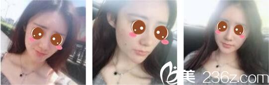 韓國(guó)奧拉克皮膚科整外科樸帝泳鼻綜合真人案例術(shù)后一個(gè)月 韓國(guó)奧拉克皮膚科整外科樸帝泳鼻綜合真人案例術(shù)后一個(gè)月