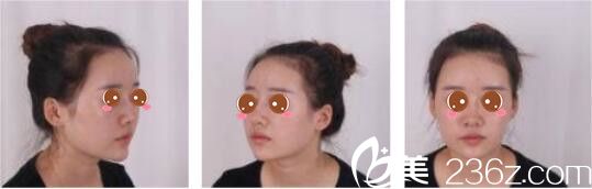 韓國(guó)奧拉克皮膚科整外科樸帝泳鼻修復(fù)真人案例術(shù)前照 韓國(guó)奧拉克皮膚科整外科樸帝泳鼻修復(fù)真人案例術(shù)前照