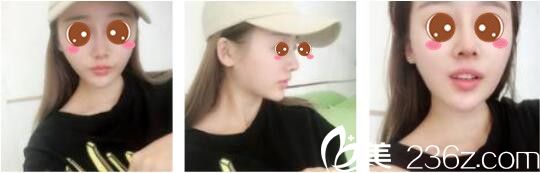 韓國(guó)奧拉克皮膚科整外科樸帝泳鼻修復(fù)真人案例術(shù)后一個(gè)月 韓國(guó)奧拉克皮膚科整外科樸帝泳鼻修復(fù)真人案例術(shù)后一個(gè)月