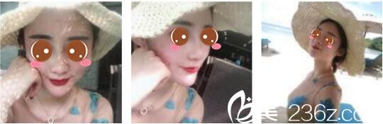 韓國(guó)奧拉克皮膚科整外科樸帝泳鼻綜合真人案例術(shù)后二十二天 韓國(guó)奧拉克皮膚科整外科樸帝泳鼻綜合真人案例術(shù)后二十二天