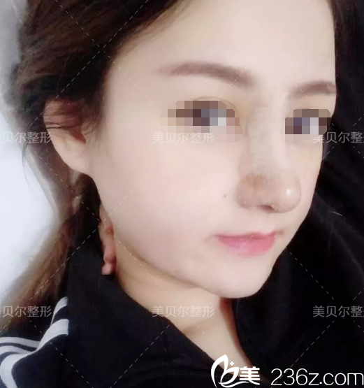 術(shù)后五天鼻綜合恢復(fù)中 術(shù)后五天鼻綜合恢復(fù)中