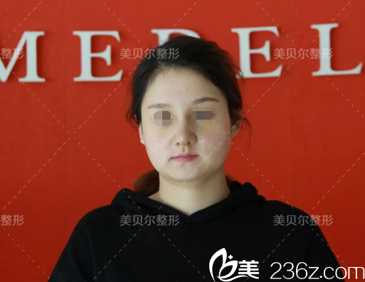 一周拆線后鼻綜合恢復(fù) 一周拆線后鼻綜合恢復(fù)