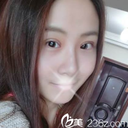 做完埋線雙眼皮10天恢復(fù)照