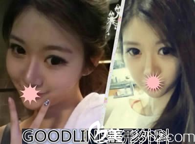 在韓國崔德浩整形外科做了雙眼皮/假體隆鼻和面部輪廓后變成了童顏臉