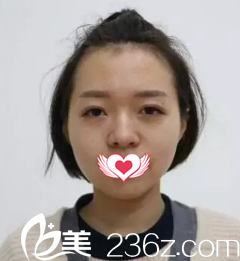 術(shù)前鼻子塌平 術(shù)前鼻子塌平