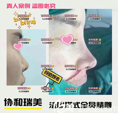 九江星瑞美隆鼻案例