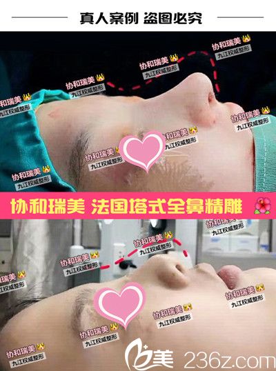 九江星瑞美隆鼻前后對比