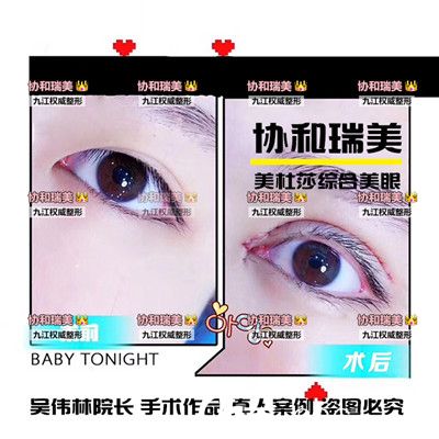 吳偉林院長雙眼皮手術(shù)案例