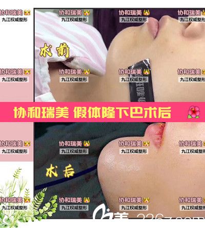 假體隆下巴案例