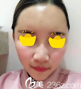 做完自體脂肪豐額頭術(shù)后天 做完自體脂肪豐額頭術(shù)后天