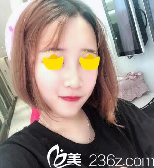 自體脂肪填充面部第4天 自體脂肪填充面部第4天