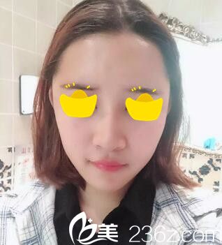 分享我在三亞紅妝尚整形醫(yī)院做自體脂肪填充額頭術(shù)后半個(gè)月恢復(fù)過(guò)程及效果