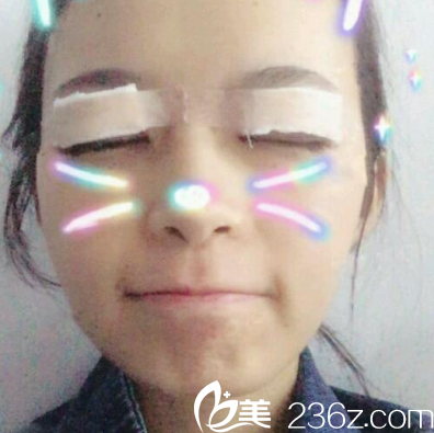 珠海艾瑞整形醫(yī)院祝小偉雙眼皮即刻效果 珠海艾瑞整形醫(yī)院祝小偉雙眼皮即刻效果