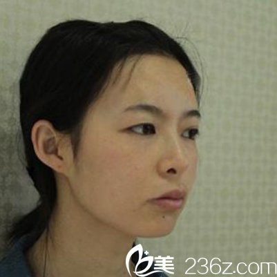 在珠海艾瑞整形美容醫(yī)院做雙眼皮手術前 在珠海艾瑞整形美容醫(yī)院做雙眼皮手術前