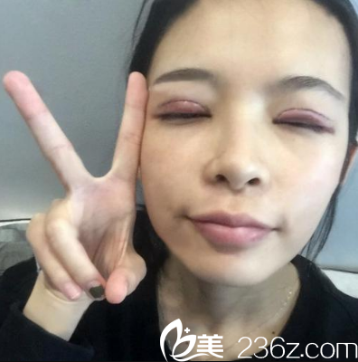 切開雙眼皮手術第三天 切開雙眼皮手術第三天