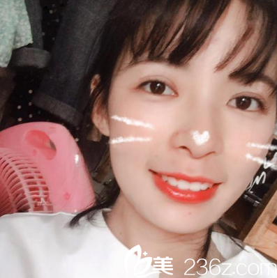 看媽媽陪我找珠海艾瑞整形美容醫(yī)院祝小偉院長(zhǎng)做的切開雙眼皮好看嗎