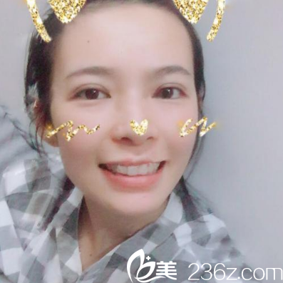 珠海艾瑞整形美容醫(yī)院祝小偉做的雙眼皮案例圖 珠海艾瑞整形美容醫(yī)院祝小偉做的雙眼皮案例圖