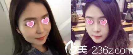 北京米蘭柏羽麗都注射瘦臉前后對(duì)比效果 北京米蘭柏羽麗都注射瘦臉前后對(duì)比效果