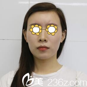 自體脂肪填充面部術(shù)前照 自體脂肪填充面部術(shù)前照