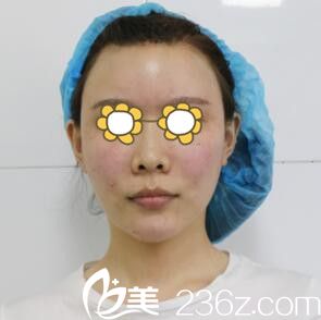 做自體脂肪填充面部當(dāng)天效果 做自體脂肪填充面部當(dāng)天效果