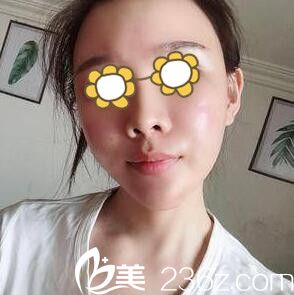 在長沙希美做自體脂肪填充面部術(shù)后一周 在長沙希美做自體脂肪填充面部術(shù)后一周