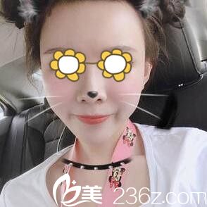 做面部自體脂肪填充面部半個月效果 做面部自體脂肪填充面部半個月效果