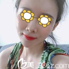 看我在長沙希美整形醫(yī)院做的自體脂肪填充面部一個月后恢復(fù)效果怎么樣？