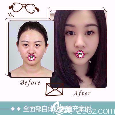 雅芳亞面部填充案例