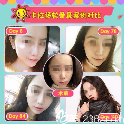 石家莊雅芳亞隆鼻案例