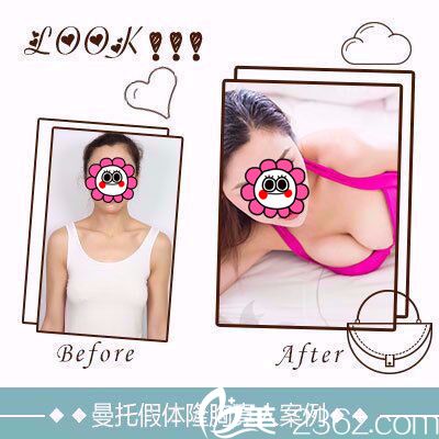 雅芳亞曼托假體隆胸案例