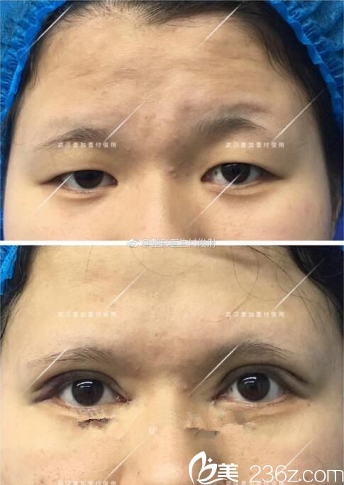 付俊俐雙眼皮前后對比案例