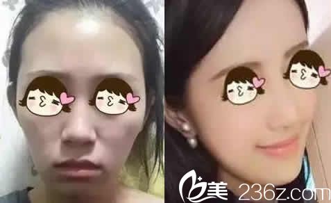 太原華美李晨陽玻尿酸面部填充案例效果圖