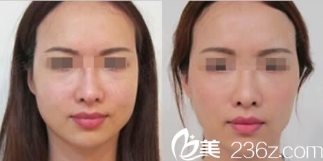 東莞締美醫(yī)療美容陳星光面部注射效果圖 東莞締美醫(yī)療美容陳星光面部注射效果圖