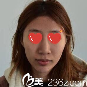 假體綜合隆鼻術(shù)前照 假體綜合隆鼻術(shù)前照