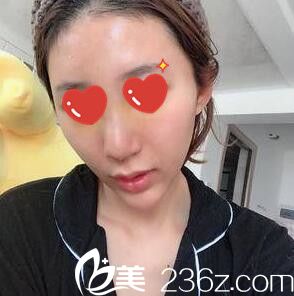 做假體綜合隆鼻術(shù)后一周拆線 做假體綜合隆鼻術(shù)后一周拆線