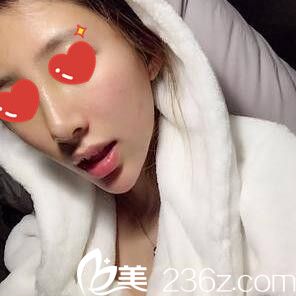 在<!--<i data=20240703-sp></i>-->做假體綜合隆鼻術(shù)后半個(gè)月<span style= 在<!--<i data=20240703-sp></i>-->做假體綜合隆鼻術(shù)后半個(gè)月<span style=