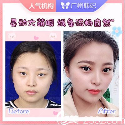 廣州韓妃整形醫(yī)院<!--<i data=20240703-sp></i>-->軍做的切開雙眼皮案例