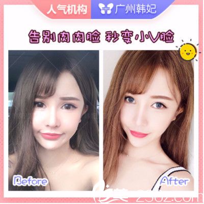 廣州韓妃<!--<i data=20240703-sp></i>-->軍做的面部吸脂案例