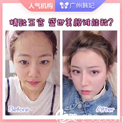 廣州韓妃<!--<i data=20240703-sp></i>-->軍做的雙眼皮隆鼻脂肪填充案例