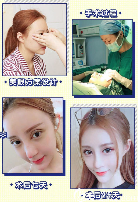 廣州韓妃王媛醫(yī)生割的雙眼皮案例圖片 廣州韓妃王媛醫(yī)生割的雙眼皮案例圖片