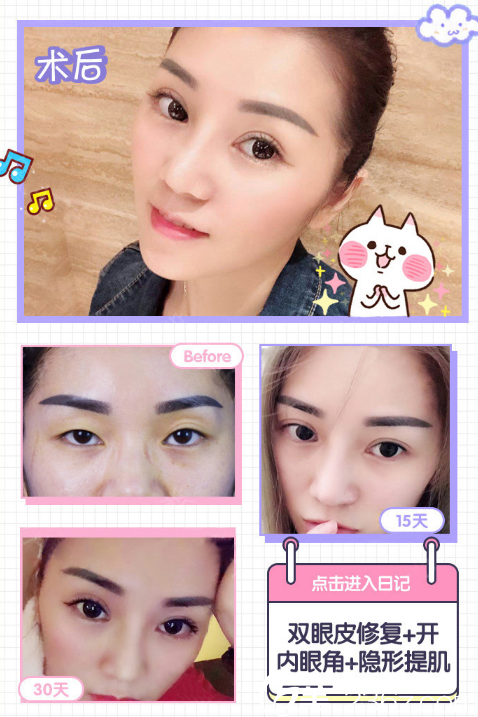 廣州韓妃王媛醫(yī)生做的雙眼皮失敗修復(fù)案例過程圖片 廣州韓妃王媛醫(yī)生做的雙眼皮失敗修復(fù)案例過程圖片