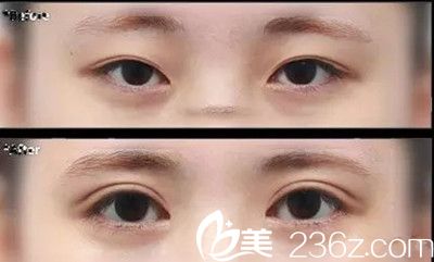 埋線雙眼皮能維持多久？