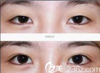 埋線雙眼皮術(shù)后護(hù)理