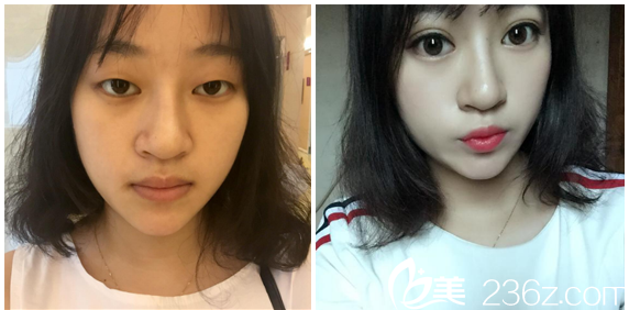 廣州韓妃楊德發(fā)做的雙眼皮案例圖 廣州韓妃楊德發(fā)做的雙眼皮案例圖