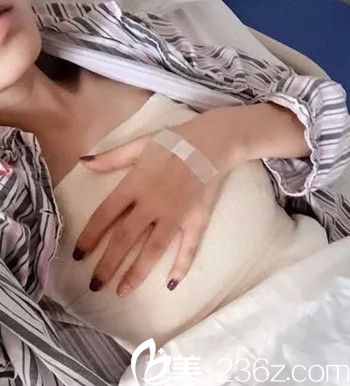 吳偉林醫(yī)生給我做假體隆胸手術(shù)后4天