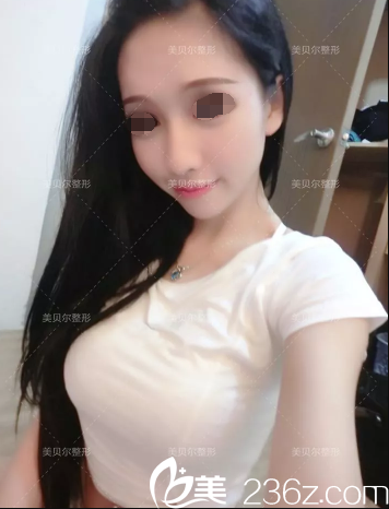 術(shù)后三個月假體隆胸恢復(fù) 術(shù)后三個月假體隆胸恢復(fù)