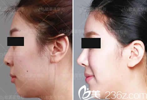 太原歐美蓮雷雪華隆鼻效果圖