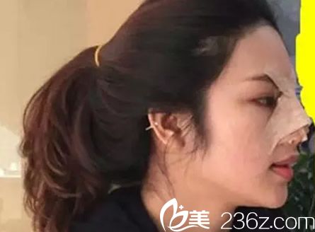 鼻綜合隆鼻天 鼻綜合隆鼻天