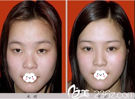 淮北相山時(shí)光王鋒仿生隆鼻案例 淮北相山時(shí)光王鋒仿生隆鼻案例